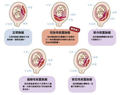 前置胎盤原因|馬偕紀念醫院 衛教單張：前置胎盤